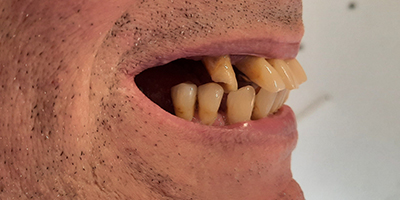 02dientes-en-un-dia-trabajos