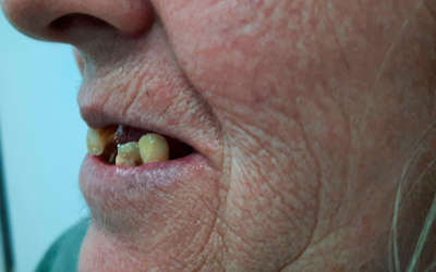 Implantes_Dentales_Despues2